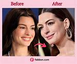 Anne Hathaways Plastic Surgery in 2 Rhinoplasty, Boob Job, & Botox Injection Rumors Examined!