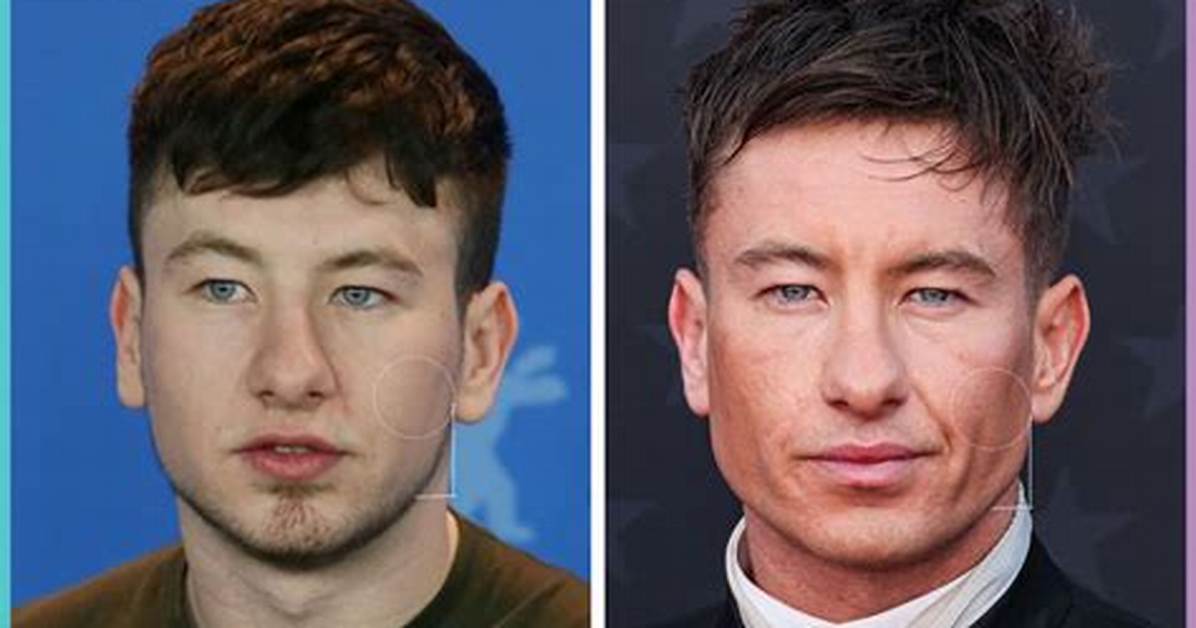 Barry Keoghan's Plastic Surgery: Before and After Transformation