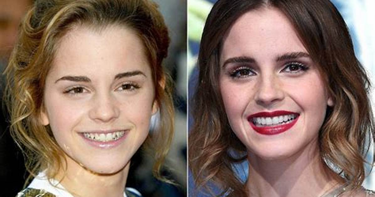 Celebrity Teeth Before & After: Dental Whitening Makeovers