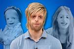Courageous Faces: Celebrities with Treacher Collins Syndrome