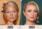 Did Cosmetic Surgery Transform Paris Hilton's Iconic Look?