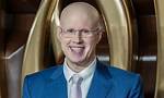 Does Matt Lucas Have Hair Loss?