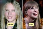 Does Taylor Swift Have Fake Teeth? or Did She Get Veneers?
