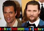 Matthew Mcconaughey's Guide to Plastic Surgery: Unlocking Youthful Beauty