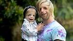 Meet the Extraordinary Individuals with Treacher Collins Syndrome: Famous Faces of Resilience