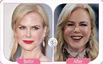 Nicole Kidman Facelift: a Comprehensive Look at Her Transformation and Impact on the Beauty Industry