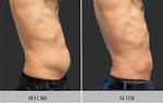 Pictures of Pah After Coolsculpting
