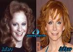 Reba Mcentires Plastic Surgery: the Truth Behind Her Ageless Beauty