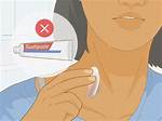 Say Goodbye to Hickeys: Effective Ways to Get Rid of Them