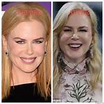 Secrets Revealed: Nicole Kidman's Plastic Surgery Transformation