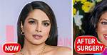 Sherlyn Chopra's Plastic Surgery Journey: Before and After
