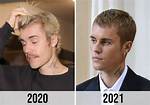 The Evolution of Justin Bieber's Hairline: from Boyish Charm to Mature Elegance