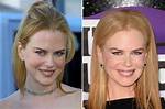 The Unveiled Truth: Nicole Kidman's Plastic Surgery Journey Explored