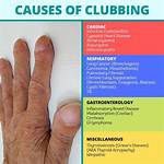 Understanding Clubitis Disease Symptoms in Adults: a Comprehensive Guide