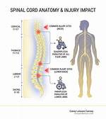 Understanding T12 Spinal Cord Injury: Impacts and Rehabilitation