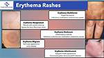 Unlock the Secrets of Diffuse Mildly Erythematous Mucosa: Discoveries and Insights