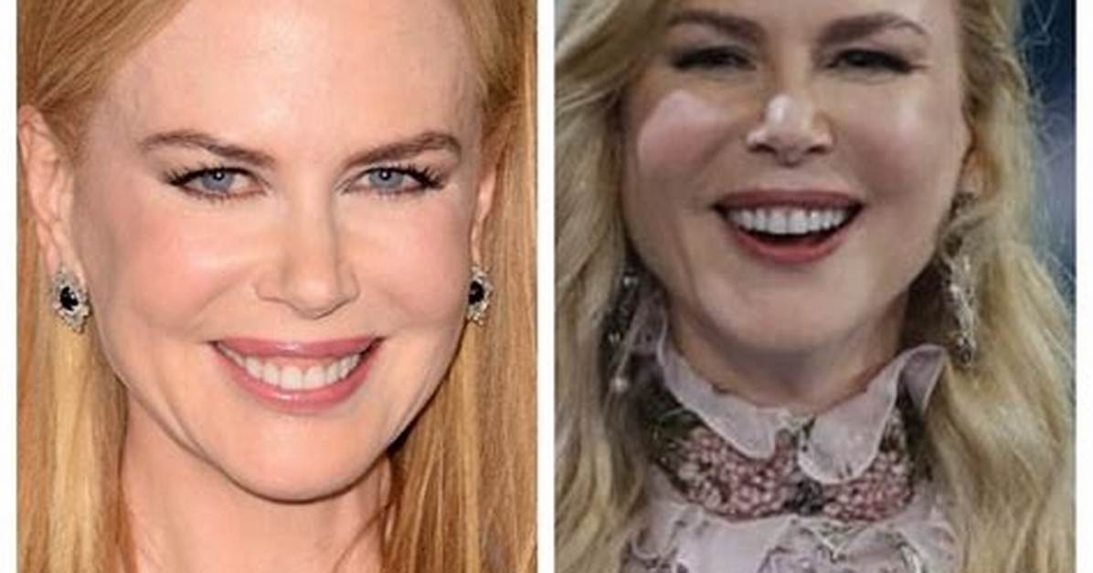 Unveiling Nicole Kidman's Plastic Surgery Transformation: Before and After