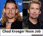 Unveiling the Truth Behind Chad Kroeger Cosmetic Surgery: a Deep Dive