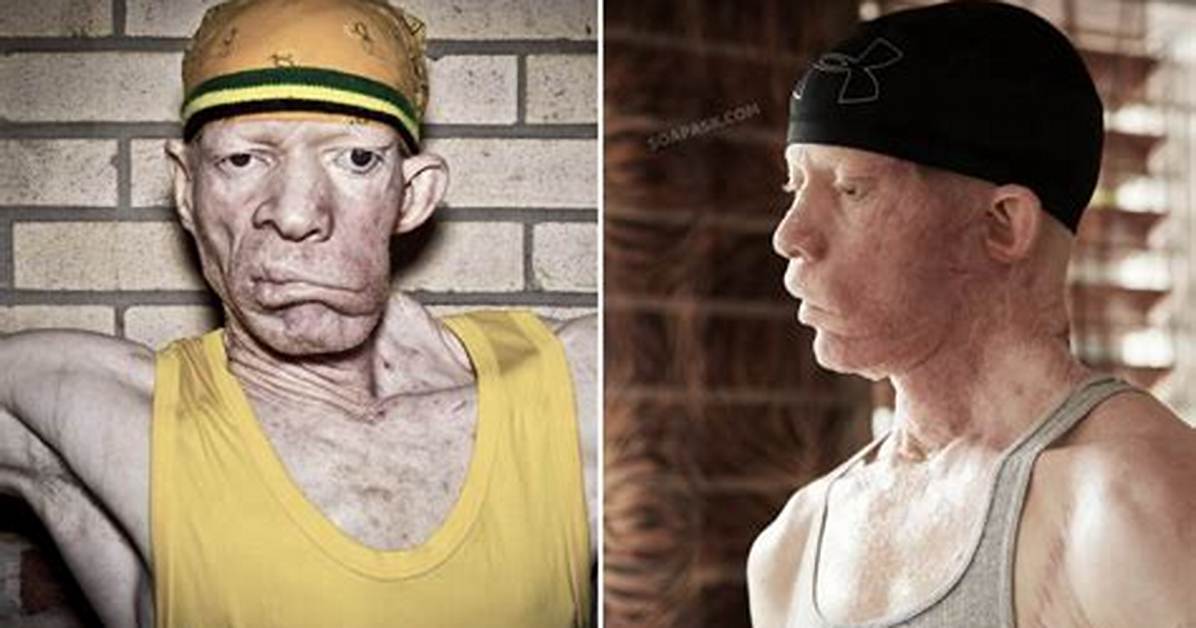 What Happened to Yellowman Face? Tumor Surgery Result Partial Distorted Face